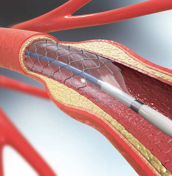 Angioplastia coronariana com implante de stent em Manaus