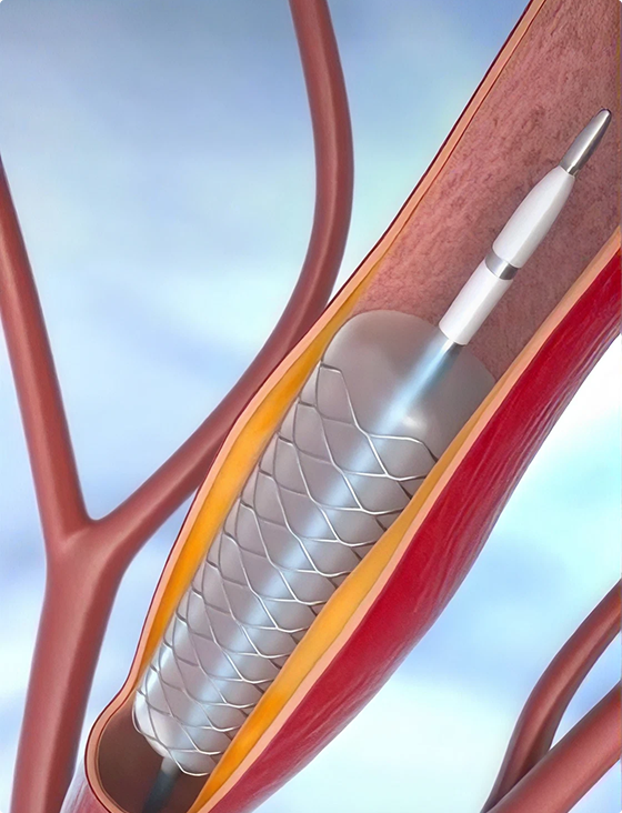 Angioplastia coronariana com stent