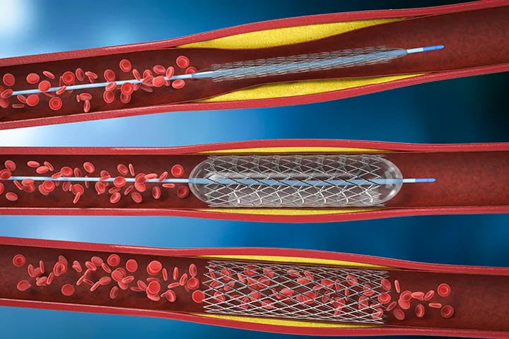 Angioplastia coronariana: quando o procedimento é necessário?